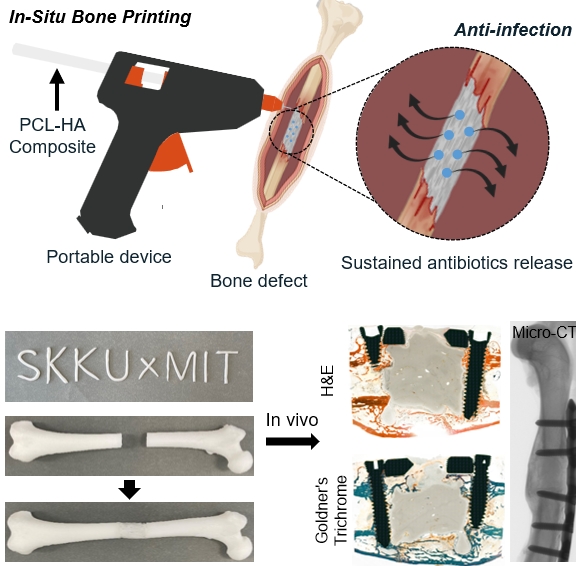 In-situ Printing of a Biodegradable Implant for a Critical-sized Bone Defect